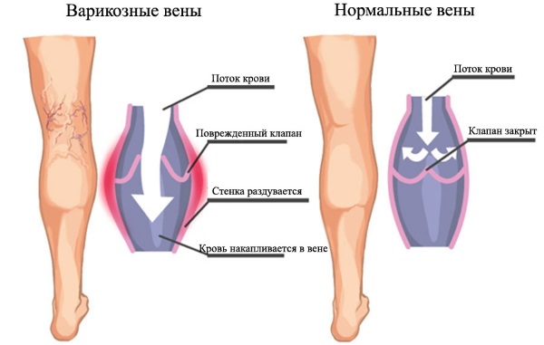 Крем Зорька. Инструкция по применению для людей от трещин на пятках, при варикозе, псориазе, пяточной шпоре, дерматите, экземе, геморрое
