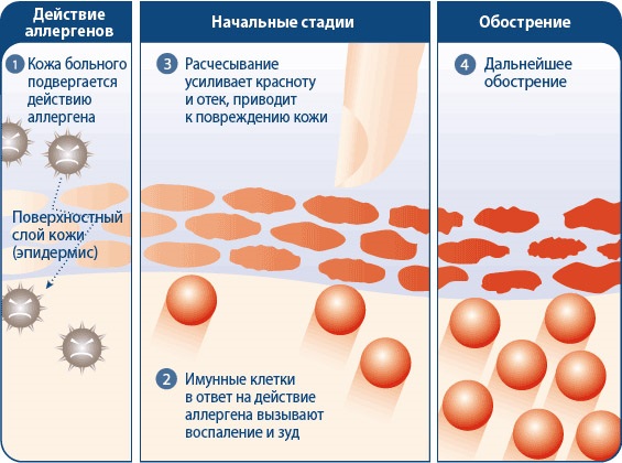 Крем Зорька. Инструкция по применению для людей от трещин на пятках, при варикозе, псориазе, пяточной шпоре, дерматите, экземе, геморрое