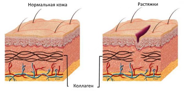 Крем Зорька. Инструкция по применению для людей от трещин на пятках, при варикозе, псориазе, пяточной шпоре, дерматите, экземе, геморрое