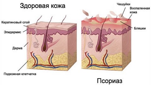 Крем Зорька. Инструкция по применению для людей от трещин на пятках, при варикозе, псориазе, пяточной шпоре, дерматите, экземе, геморрое