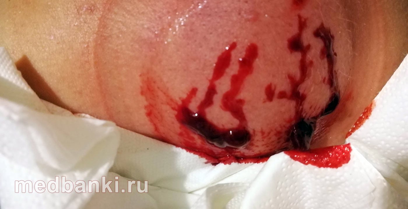 Капельное кровотечение в результате хиджамы