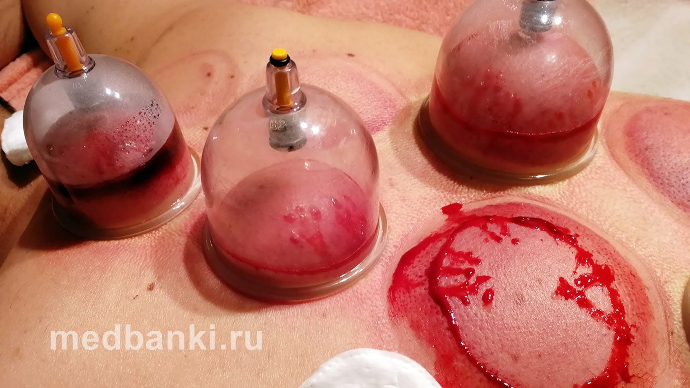 Кровопускание на спине