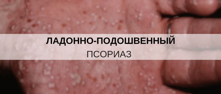 Чем лечить псориаз на ладонях