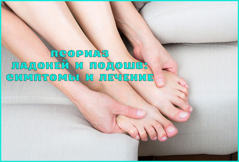 Ладонно-подошвенный псориаз: причины, симптомы и лечение