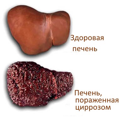 Лаеннек (Laennec) - что это, какое действие оказывает на организм. Характеристика и состав японского препарата. Стоимость