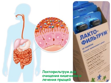 Лактофильтрум от прыщей: отзывы врачей дерматологов с фото до и после. Инструкция по применению, аналоги, цена