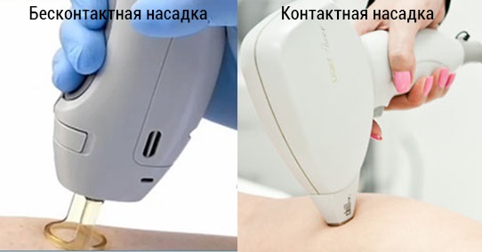Лазерная эпиляция зоны глубокое бикини. Противопоказания, фото, цена процедуры