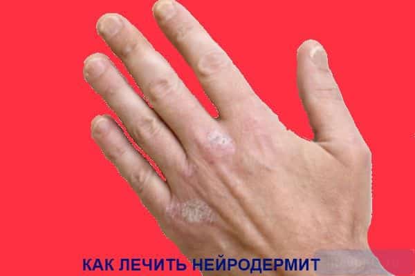 alt="Лечение нейродермита"