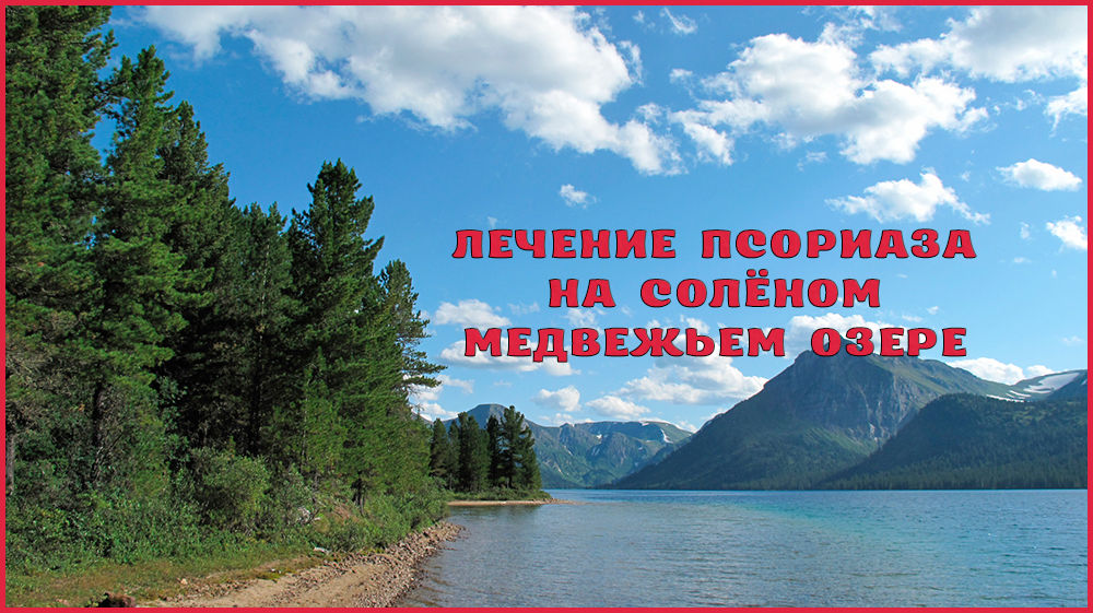Лечение псориаза на озере Медвежье