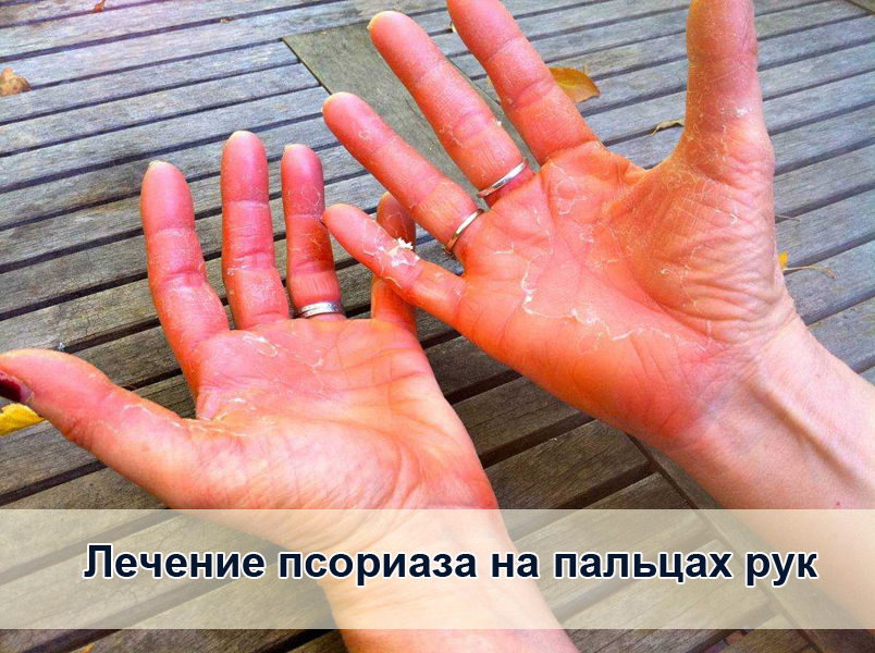 Лечение псориаза на пальцах рук