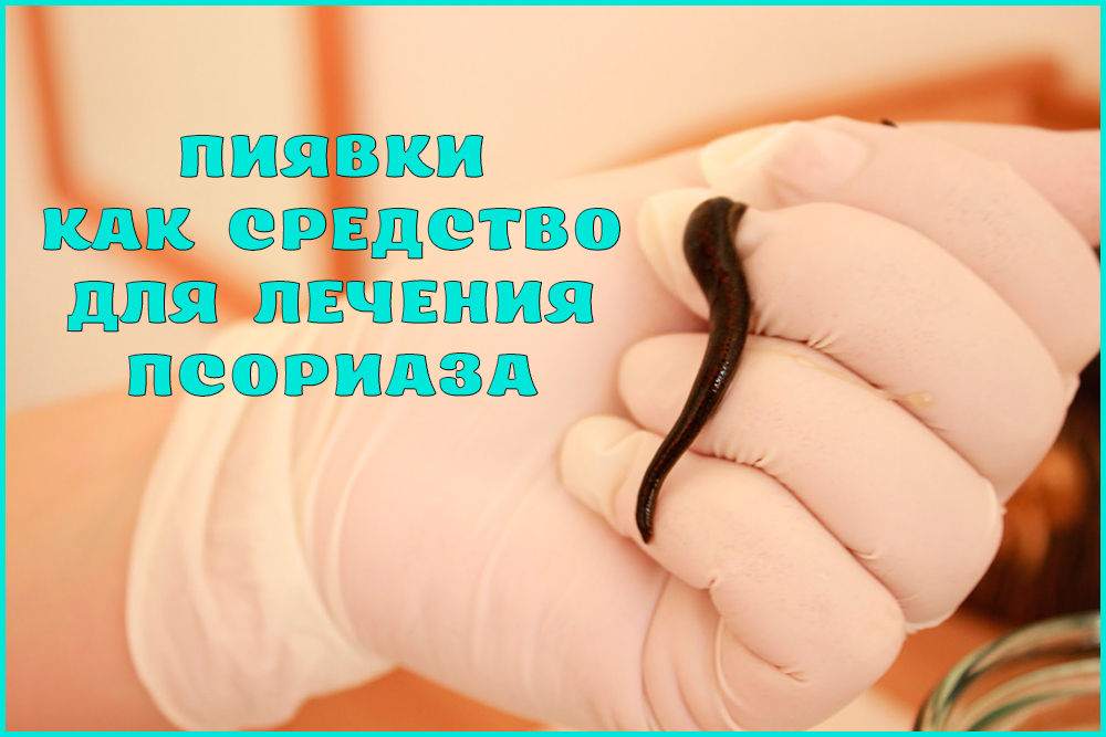 Лечение псориаза пиявками