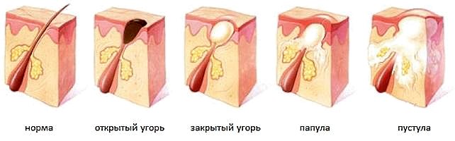 Лечение псориаза в домашних условиях активированным углем
