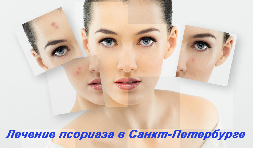 Лечение псориаза в Санкт-Петербурге