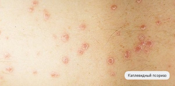 Каплевидный псориаз