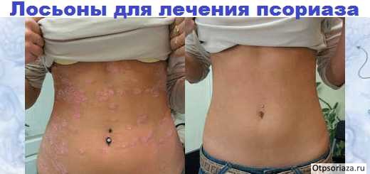 Фуфан лосьон от псориаза отзывы