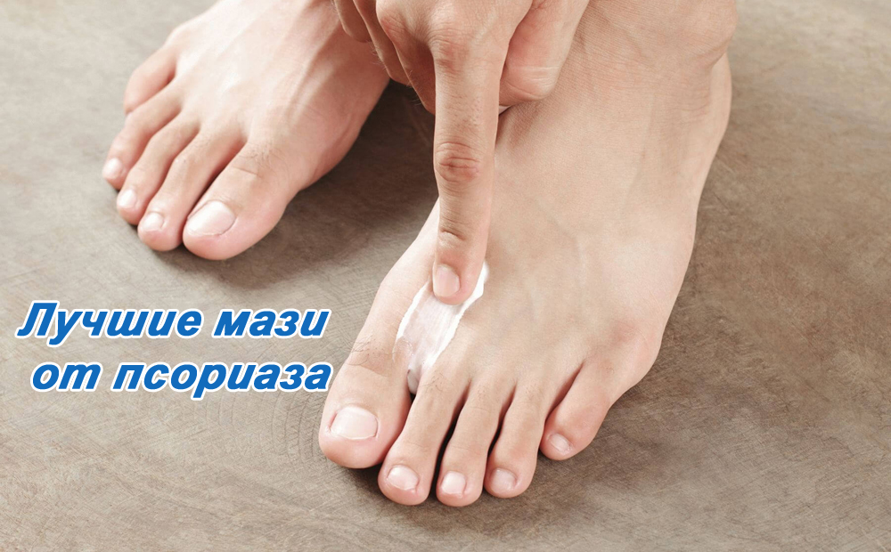 Лучшие мази от псориаза