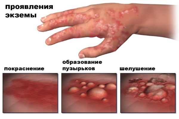 Масло чистотела. Свойства и применение при кожных и грибковых заболеваниях, в косметологии, гинекологии