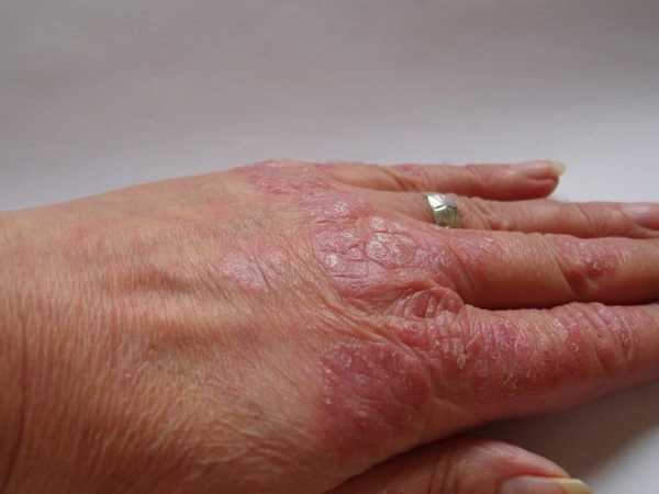 kak-izbavitsya-ot-psoriaza