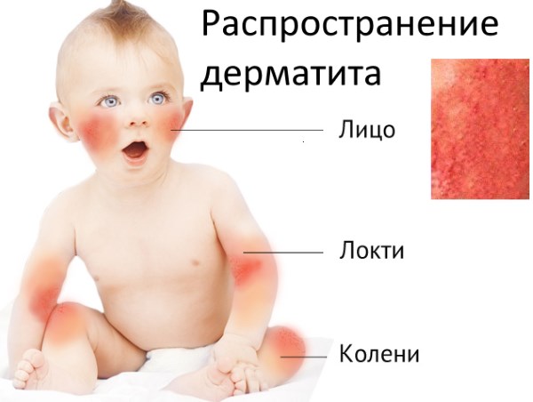 Мази от дерматита на коже у взрослых. Самые эффективные