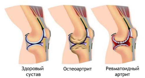Чем заменить метипред при ревматоидном артрите