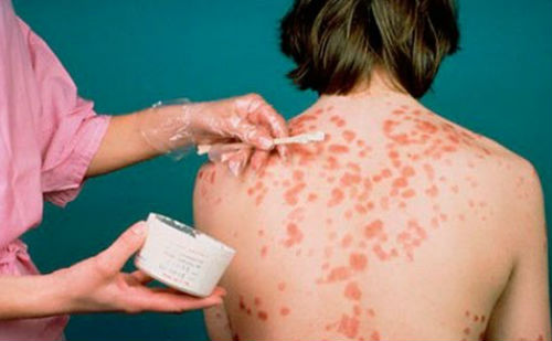 metody-lechenija-psoriaa-sodojj