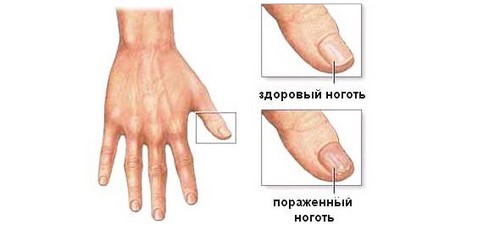  лечение псориаза ногтей