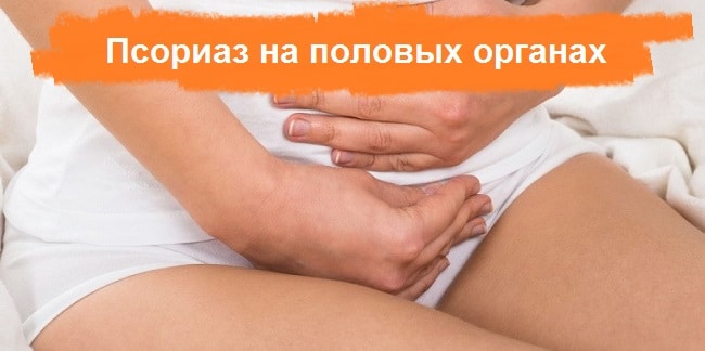 Псориаз половых органов: на половых губах у женщин, в паху мужчин