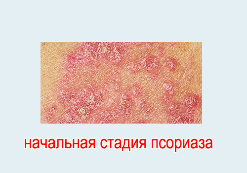 так выглядит начальная стадия псориаза