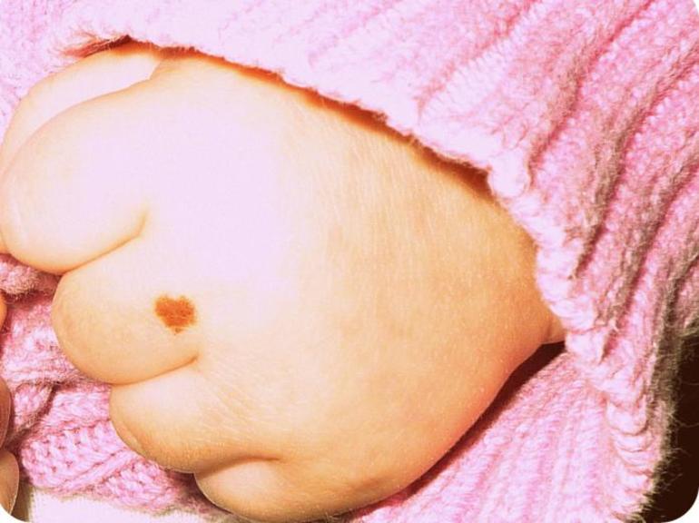 Нахождение родинок справа или слева