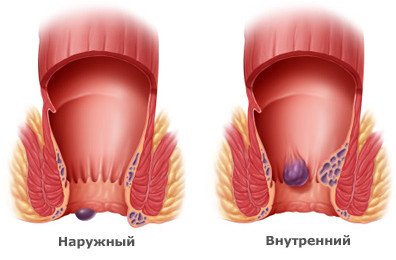От чего бывает геморрой? Основные причины возникновения геморроя