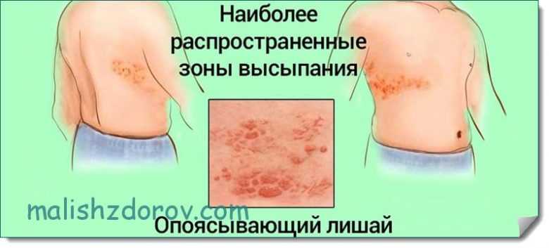 Опоясывающий лишай