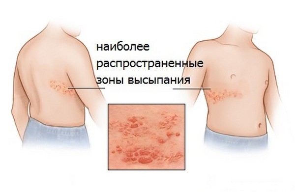 опоясывающий лишай