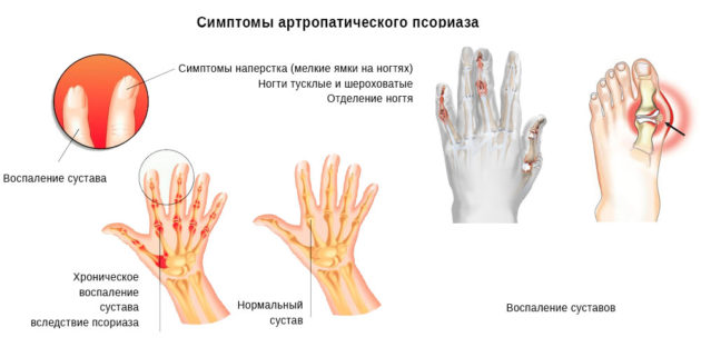 схема примера осложнения при псориазе