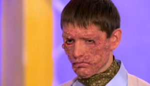 Лечение Проказы и первые признаки болезни