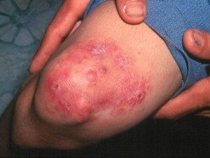 Лечение Проказы и первые признаки болезни