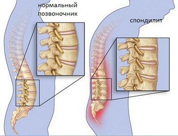 Проявление спондилоартрита