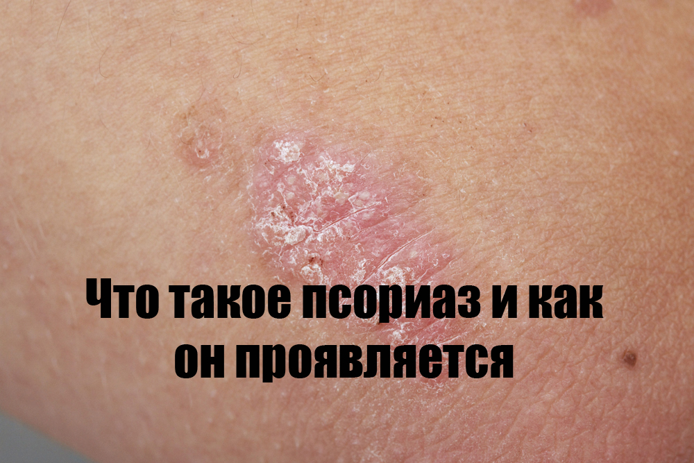Что такое псориаз и как он проявляется
