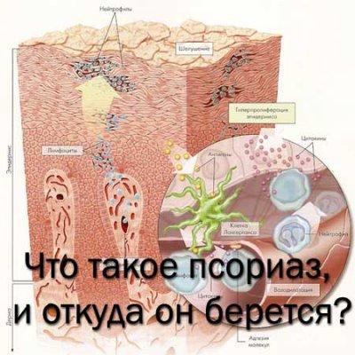 Чем опасен псориаз для здоровья мужчин и женщин