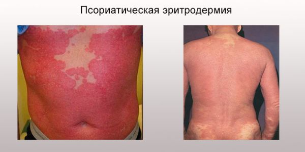 Псориатическая эритродермия фото