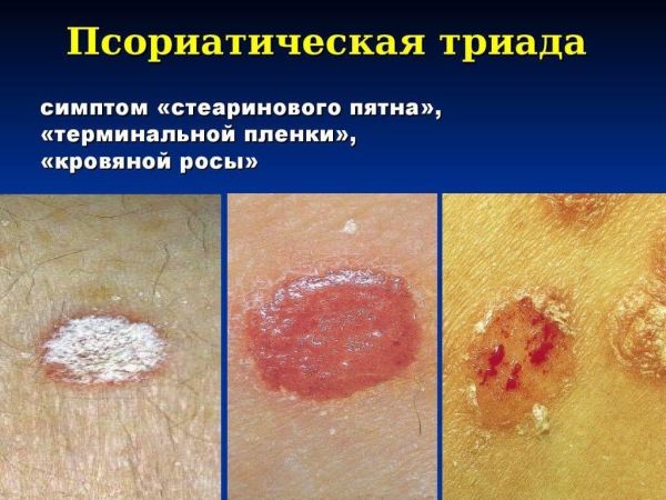 Псориатическая триада