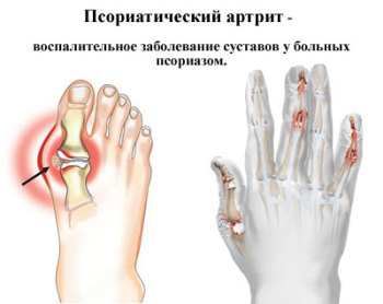 Псориатический артрит у взрослых: симптомы и лечение