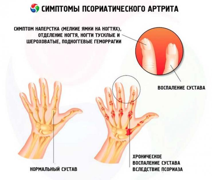Особенности протекания псориатического артрита