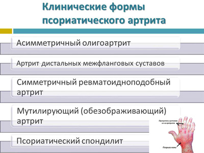 Псориатический полиартрит у детей: лечение, симптомы, причины, профилактика