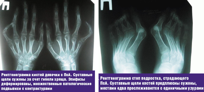 Псориатический полиартрит у детей: лечение, симптомы, причины, профилактика