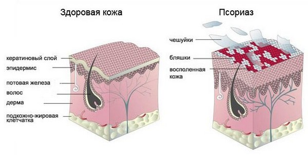 псориаз