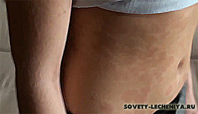 psoriaz