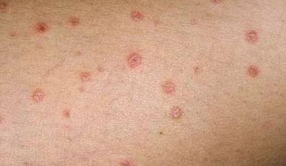 Первые признаки псориаза у женщин