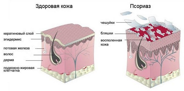 псориаз