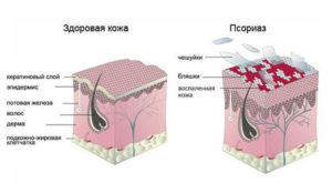 psoriaz