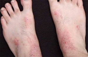 Симптомы псориаза на ногах и лечение на начальной стадии
